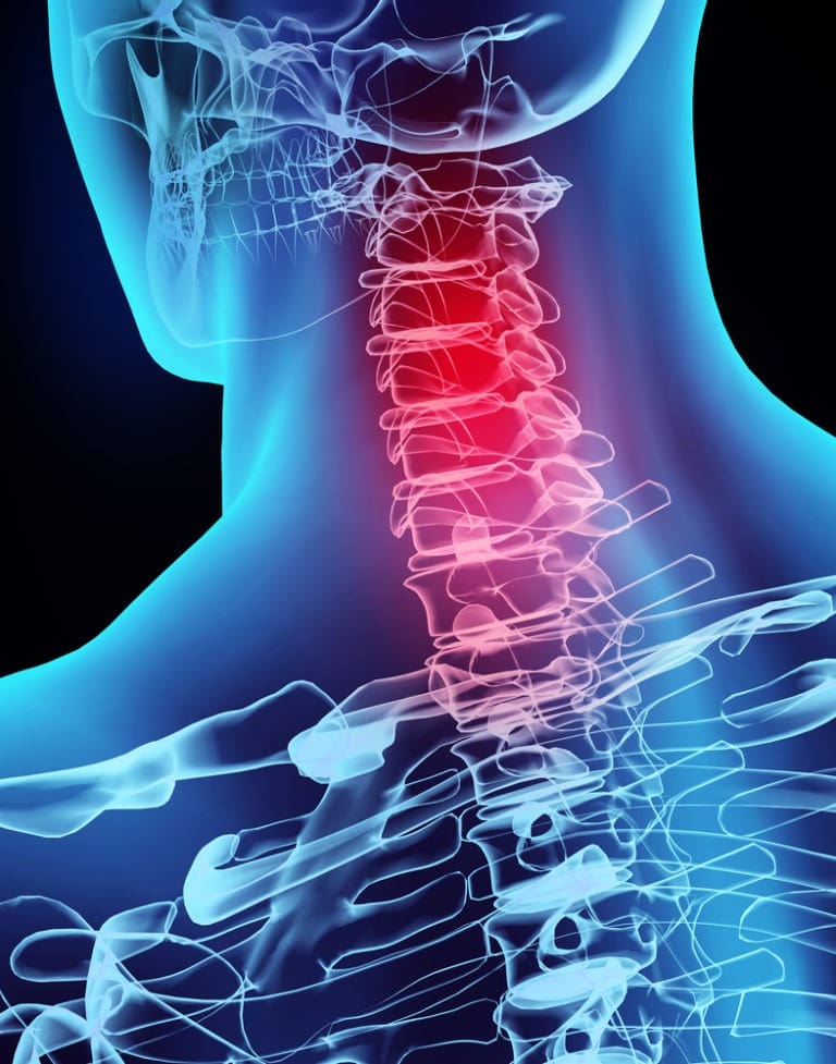 3D illustration of neck pain