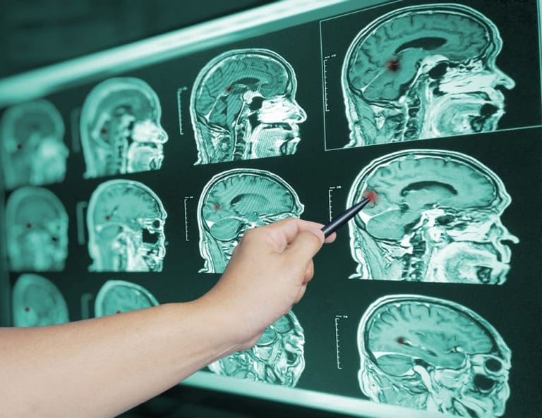 a-doctor-pointing-to-a-traumatic-brain-injury-on-a-brain-scan
