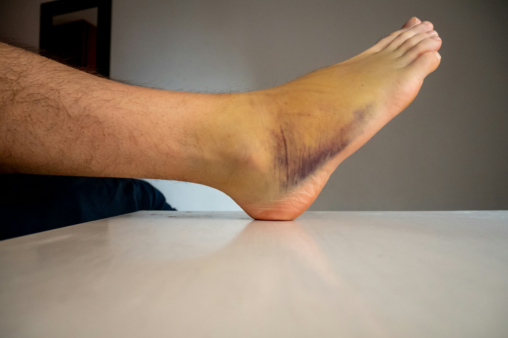 Right Foot Bruise, also known as Contusion on a Large Area with